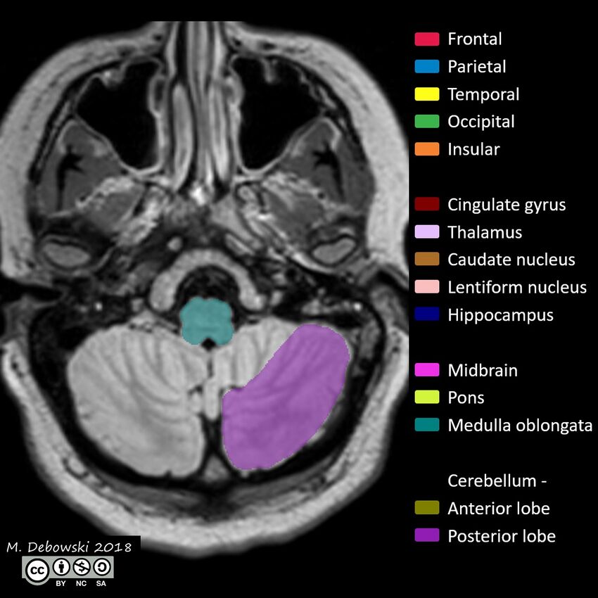 Brain lobes - annotated MRI (Radiopaedia 61691-69700 Axial 67).JPG