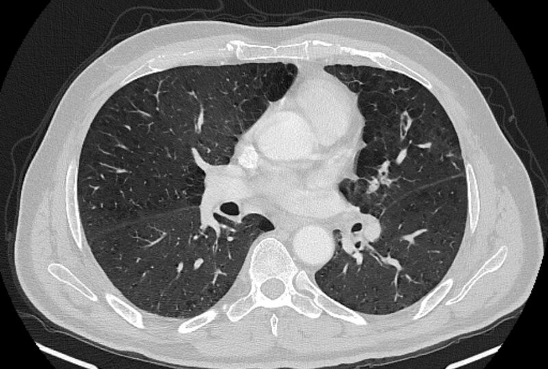 File:Brain metastases - lung cancer primary (Radiopaedia 75060-86116 Axial lung window 29).jpg