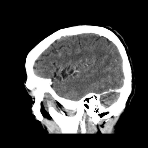 File:Brain metastases from lung cancer (Radiopaedia 24480-24781 C+ delayed 13).jpg