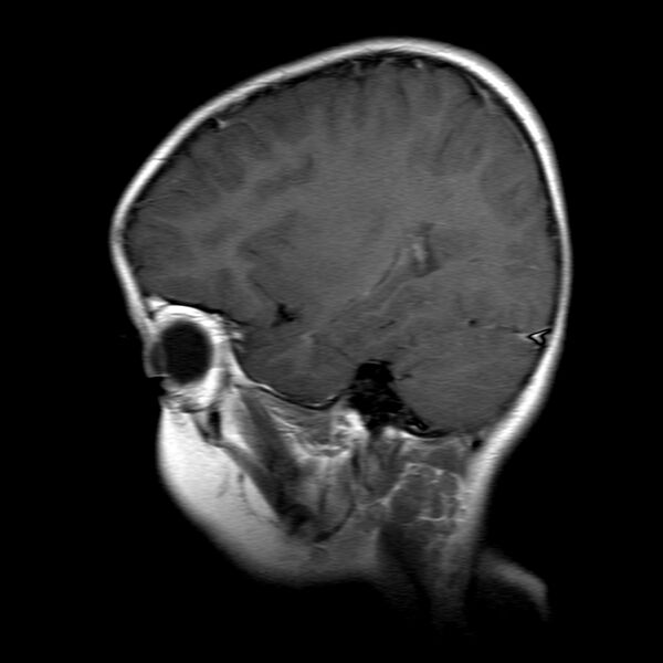 File:Brainstem ganglioglioma (Radiopaedia 10763-11224 Sagittal T1 C+ 14).jpg