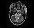 Brainstem glioma (Radiopaedia 21819-21775 Axial T2 10).jpg