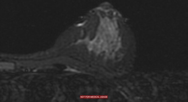 File:Breast lymphoma (MRI) (Radiopaedia 34999-36498 Axial STIR 1).jpg
