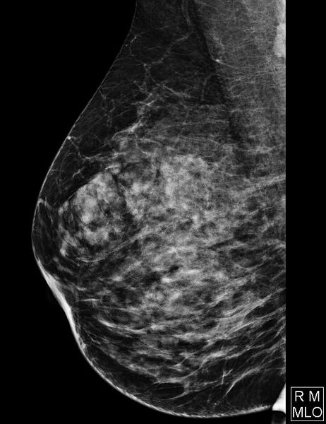 File:Breast within a breast sign - hamartoma (Radiopaedia 64005-72756 MLO 1).JPG