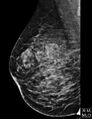 Breast within a breast sign - hamartoma (Radiopaedia 64005-72756 MLO 1).JPG
