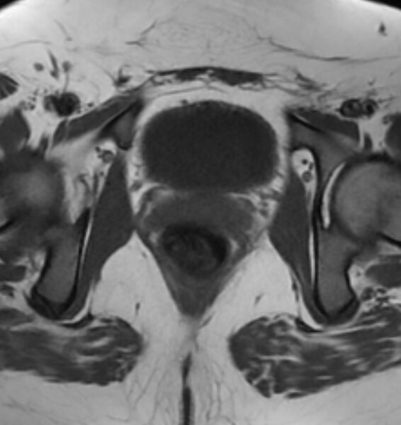 File:Broad ligament leiomyoma (Radiopaedia 81634-95516 Axial T1 22).jpg
