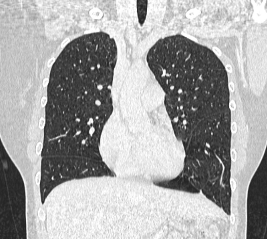 Bronchial atresia (Radiopaedia 50007-55297 Coronal lung window 37).jpg