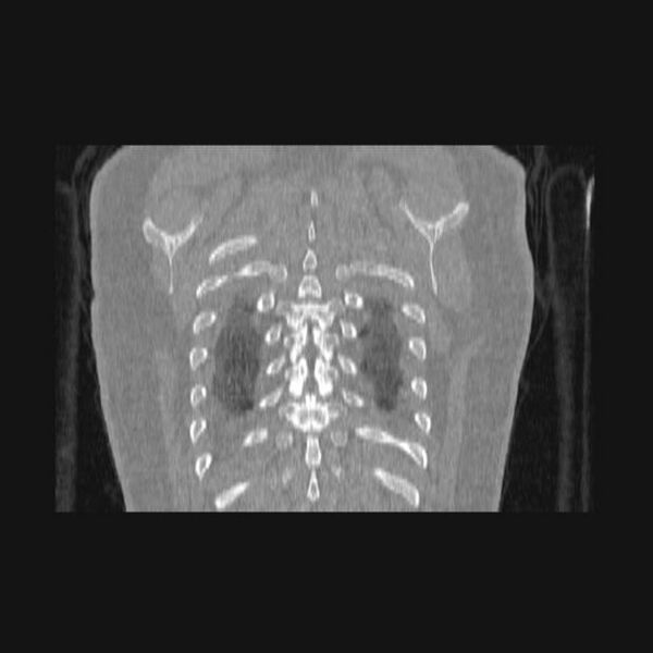 File:Bronchial atresia (Radiopaedia 60685-68439 Coronal lung window 7).jpg