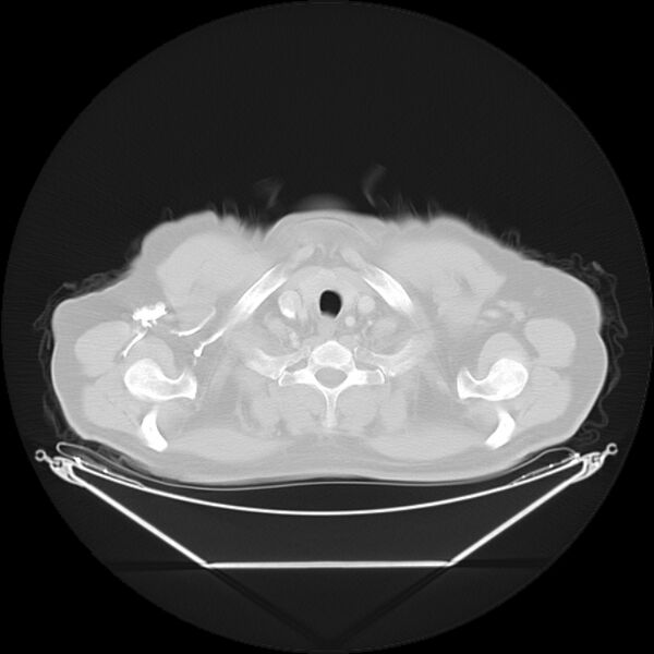 File:Bronchogenic carcinoma with upper lobe collapse (Radiopaedia 29297-29726 Axial lung window 4).jpg