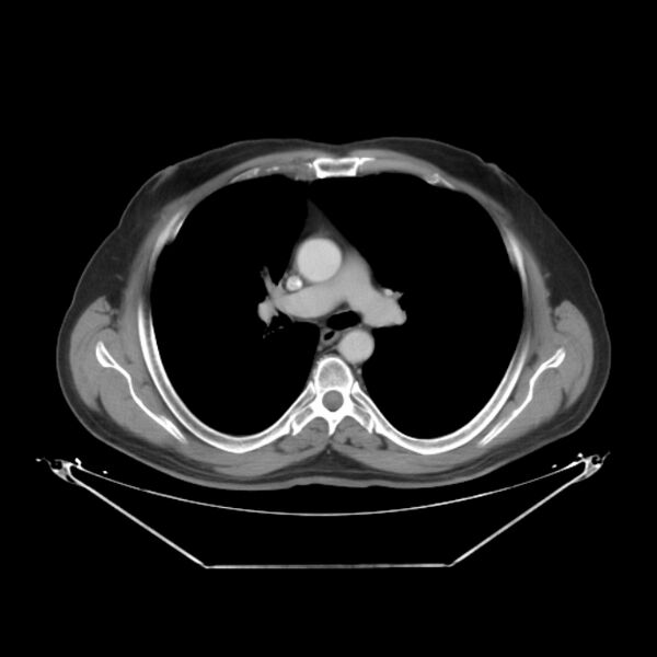 File:Bronchogenic carcinoma with upper lobe collapse (Radiopaedia 29297-29726 C 15).jpg