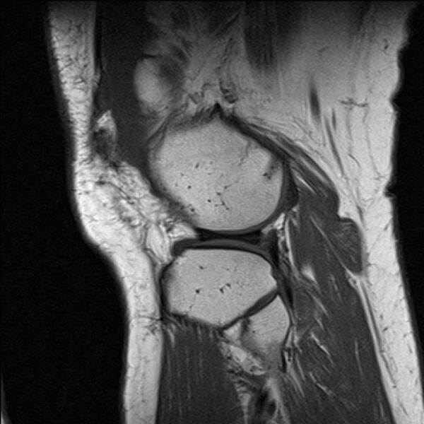 File:Bucket handle tear - medial meniscus (Radiopaedia 79028-91942 Sagittal T1 4).jpg