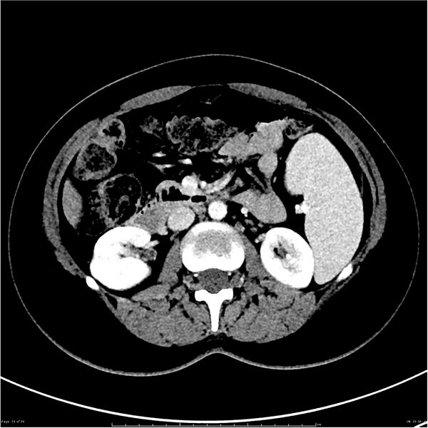 File:Budd-Chiari syndrome (Radiopaedia 27929-28177 Axial liver window 31).JPG