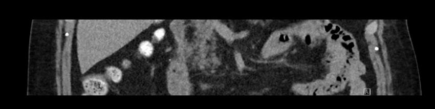 Buried bumper syndrome - gastrostomy tube (Radiopaedia 63843-72575 Coronal Inject 43).jpg