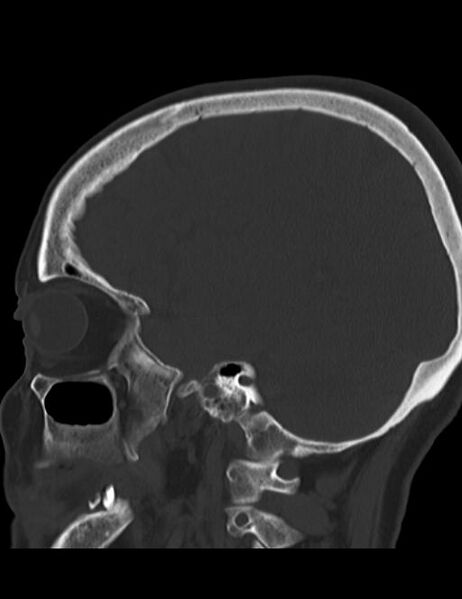 File:Burnt-out meningioma (Radiopaedia 51557-57337 Sagittal bone window 14).jpg