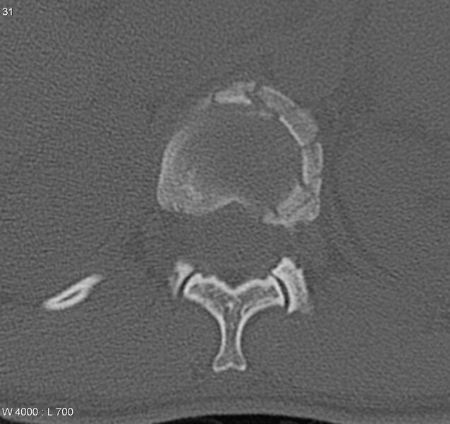 File:Burst fracture (Radiopaedia 5274-7018 Axial bone window 3).jpg