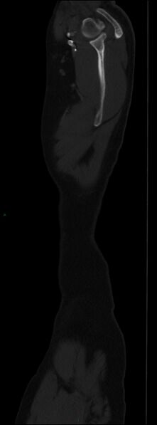 File:Burst fracture (Radiopaedia 83168-97542 Sagittal bone window 19).jpg