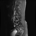 Burst fracture - lumbar spine (Radiopaedia 72877-83541 Sagittal STIR 1).jpg