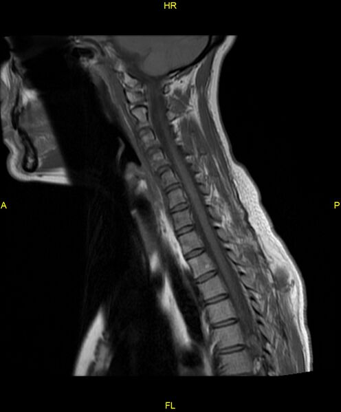 File:C5 nerve sheath tumor (Radiopaedia 85777-101596 Sagittal T1 9).jpg