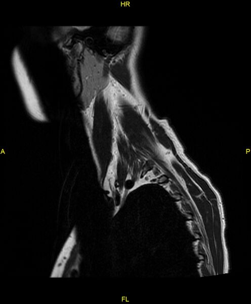 File:C5 nerve sheath tumor (Radiopaedia 85777-101596 Sagittal T2 2).jpg