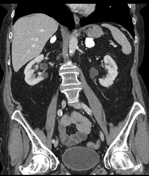 File:Calcified adrenal glands and Spigelian hernia (Radiopaedia 49741-54988 B 62).jpg