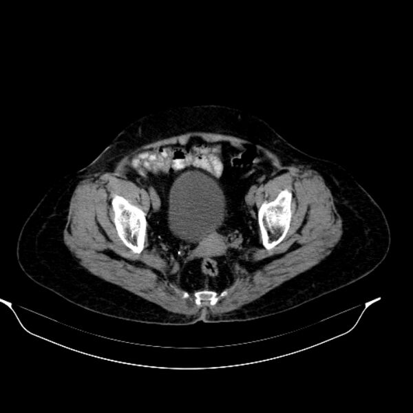 File:Calcified hydatid cyst (Radiopaedia 62000-70085 Axial non-contrast 96).jpg