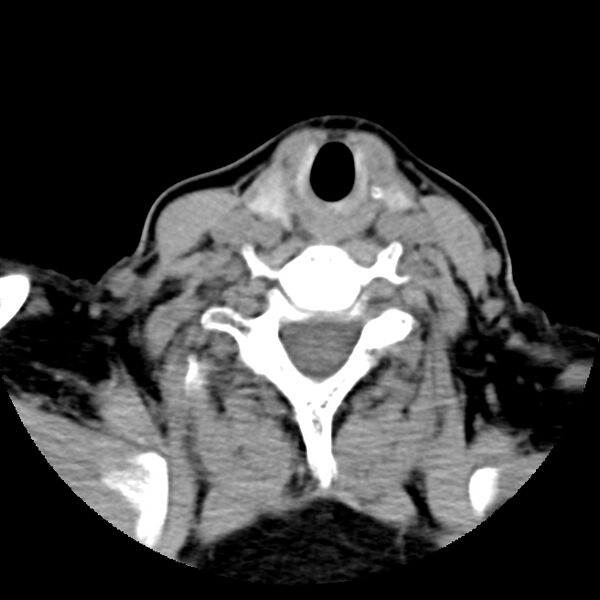 File:Calcified meningioma - cervical canal (Radiopaedia 70136-80171 B 27).jpg