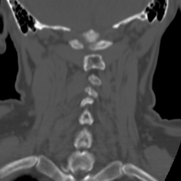 File:Calcified meningioma - cervical canal (Radiopaedia 70136-80171 Coronal bone window 28).jpg