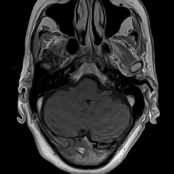 File:Calcified meningioma - cervical canal (Radiopaedia 70136-82468 Axial T1 C+ 1).jpg