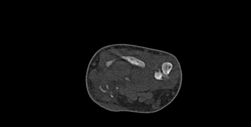 File:Calcifying aponeurotic fibroma (Radiopaedia 88423-105064 Axial bone window 40).jpg