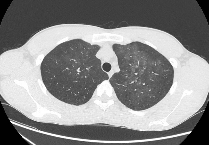 File:Cannabis-induced diffuse alveolar hemorrhage (Radiopaedia 89834-106946 Axial lung window 26).jpg
