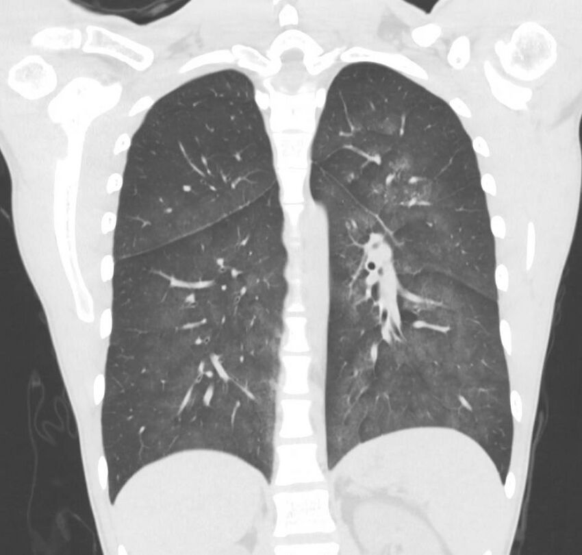 Cannabis-induced diffuse alveolar hemorrhage (Radiopaedia 89834-106946 Coronal lung window 31).jpg
