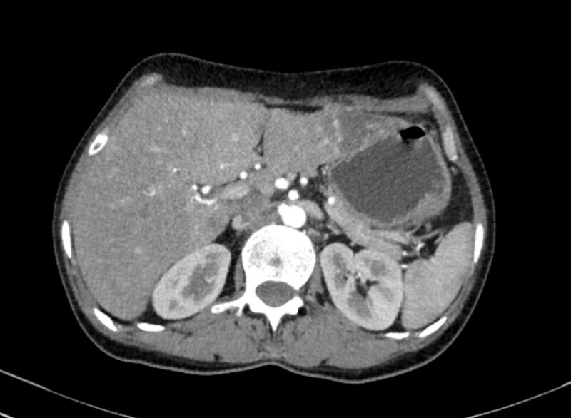 File:Cannonball metastases from breast cancer (Radiopaedia 91024-108569 A 125).jpg