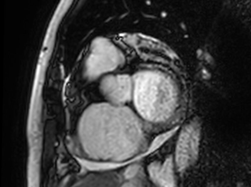 File:Cardiac amyloidosis (Radiopaedia 61600-69579 Short axis bSSFP 318).jpg