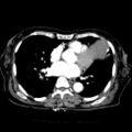Cardiac fibroma (Radiopaedia 38974-41149 A 3).jpg