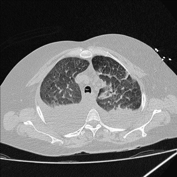 File:Cardiogenic pulmonary edema (Radiopaedia 29213-29609 Axial lung window 20).jpg
