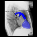 Cardiomediastinal anatomy on chest radiography (annotated images) (Radiopaedia 46331-50748 H 1).png