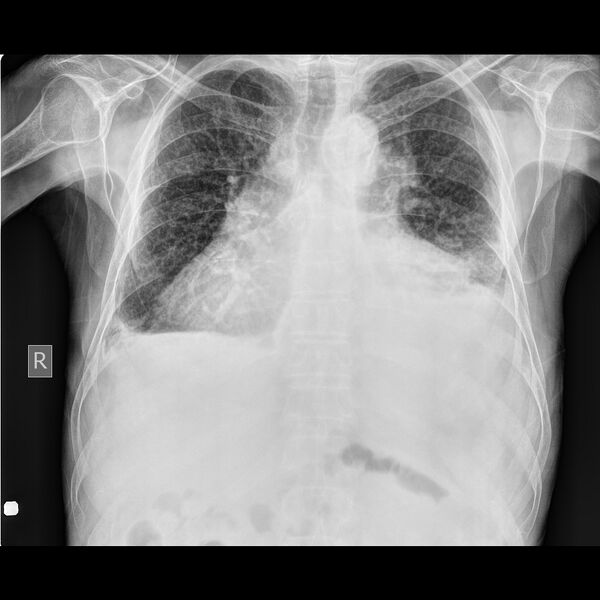 File:Cardiomegaly with bilateral pleural effusion (Radiopaedia 22793-22821 Frontal 1).JPEG