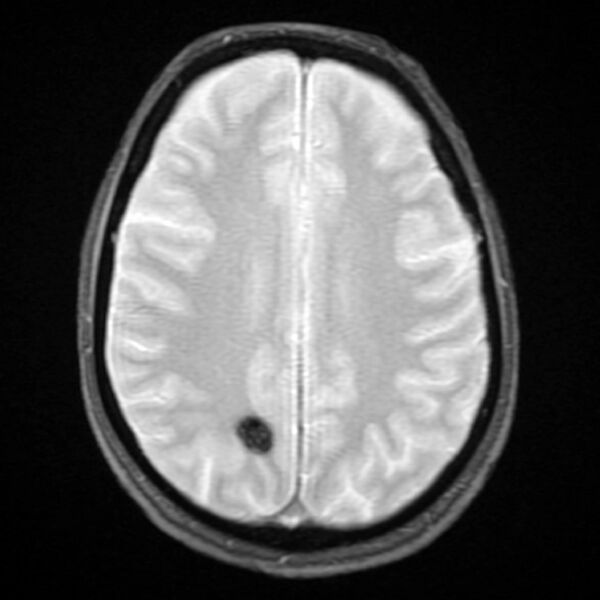 File:Cavernous hemangioma - brain (Radiopaedia 9773-10378 Axial Gradient Echo 1).jpg
