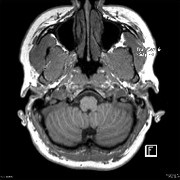 File:Cavernous malformation (cavernous angioma or cavernoma) (Radiopaedia 36675-38237 Axial T1 11).jpg