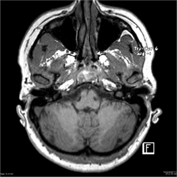 File:Cavernous malformation (cavernous angioma or cavernoma) (Radiopaedia 36675-38237 Axial T1 20).jpg