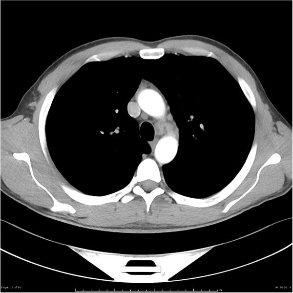 File:Cavitating lung cancer (Radiopaedia 25796-25945 C+ arterial phase 17).jpg