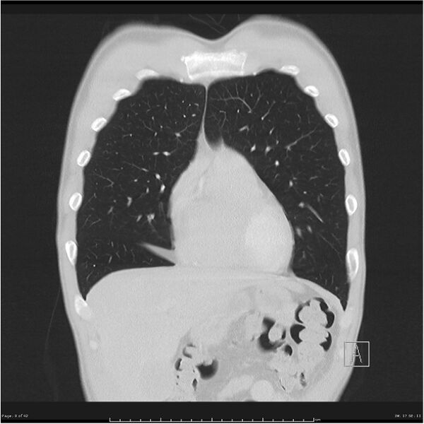 File:Cavitating lung cancer (Radiopaedia 25796-25945 lung window 9).jpg