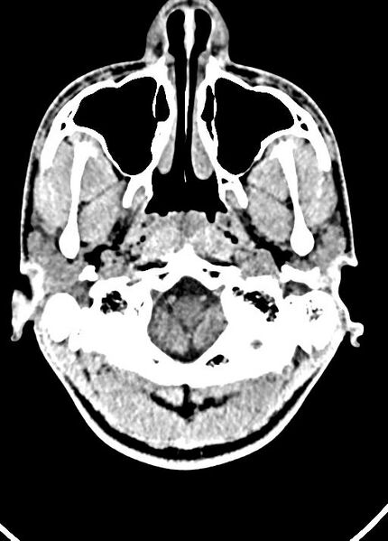 File:Cavum septum pellucidum and cavum vergae (Radiopaedia 77797-90060 Axial Brain Window 11).jpg