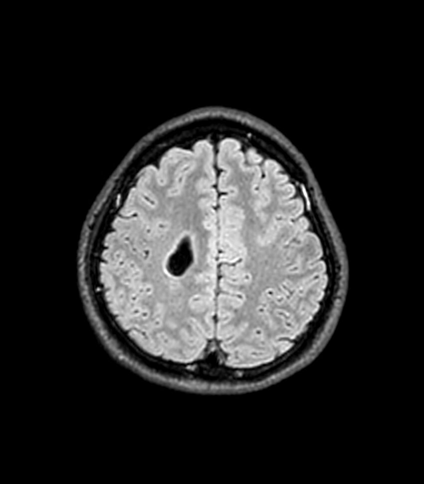 Central neurocytoma (Radiopaedia 79320-92380 Axial FLAIR 86).jpg