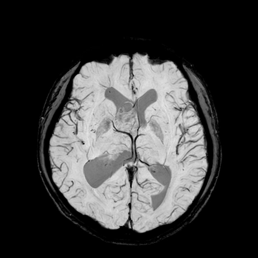 Central neurocytoma (Radiopaedia 79320-92380 Axial SWI 71).jpg