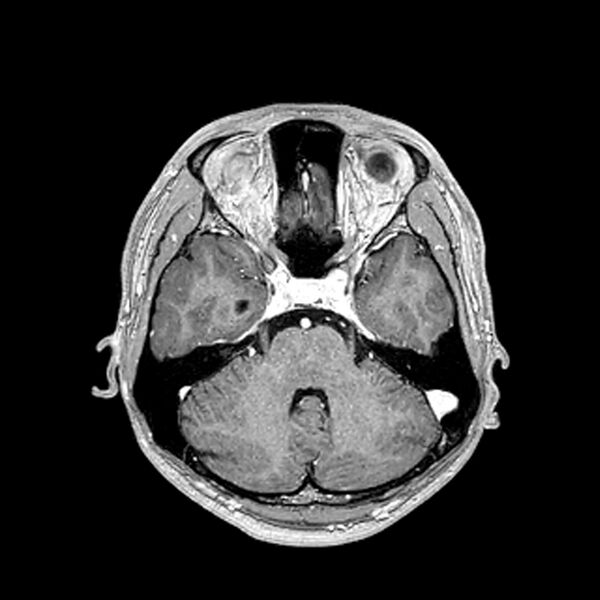 File:Central neurocytoma (Radiopaedia 79320-92380 Axial T1 C+ 85).jpg