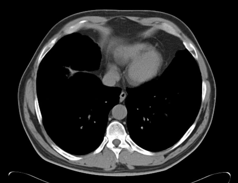 File:Centrilobular pulmonary emphysema (Radiopaedia 26808-26971 Axial non-contrast 33).jpg