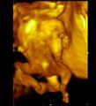 Cephalopagus conjoined twin (4D ultrasound) (Radiopaedia 84793-100256 Transverse 1).jpg