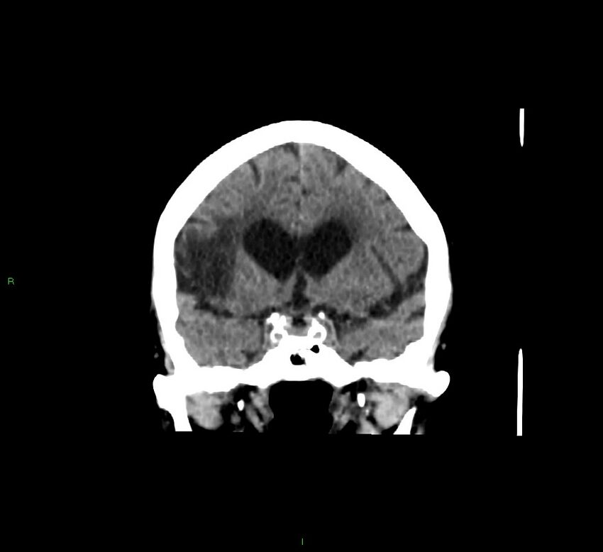 Cerebellar hemorrhage (Radiopaedia 58793-66027 Coronal non-contrast 44).jpg