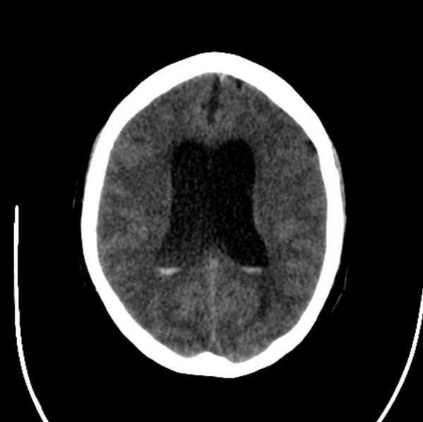 File:Cerebellar hemorrhage causing obstructive hydrocephalus (Radiopaedia 33989-35207 Axial non-contrast 32).jpg