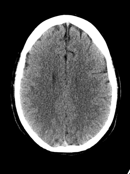 File:Cerebellar infarct due to vertebral artery dissection with posterior fossa decompression (Radiopaedia 82779-97032 Axial non-contrast 20).png